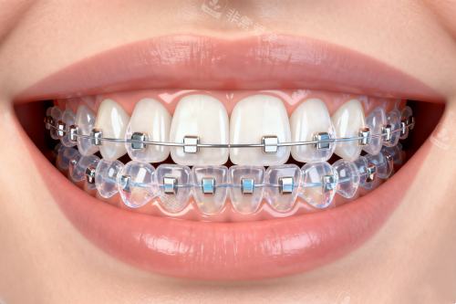 陶瓷半隐形矫正器图片一览