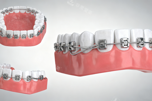 分享我韩国整牙前后对比照片！深覆合改善后下巴后缩问题有所改善！