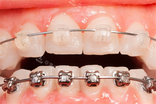 陶瓷自锁矫正器和金属自锁矫正展示 陶瓷自锁矫正器和金属自锁矫正展示