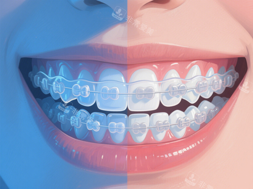 陶瓷牙套矫正 陶瓷牙套矫正