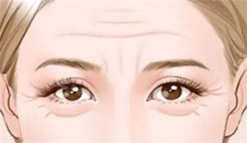 泪沟型眼袋和眼角细纹展示图