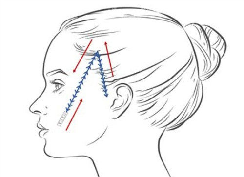 面部埋线卡通示意图 面部埋线卡通示意图