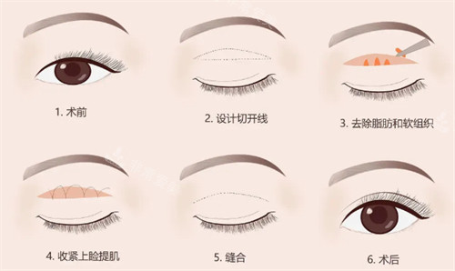 提眉手术步骤分解 提眉手术步骤分解