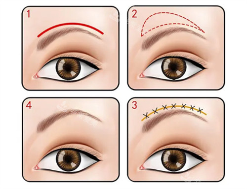 提眉不同切口 提眉不同切口