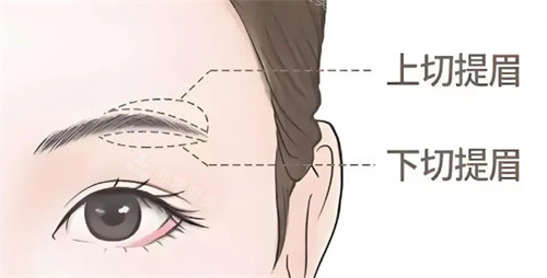 提眉术式区别 提眉术式区别