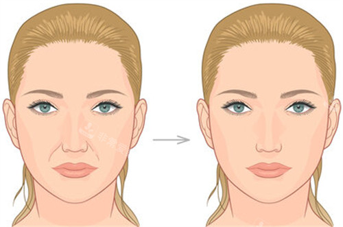 法令纹改善前后对比 法令纹改善前后对比