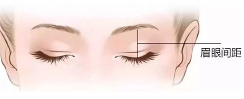 双眼皮术前设计 双眼皮术前设计