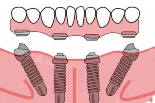 all-on-4种植模型展示图