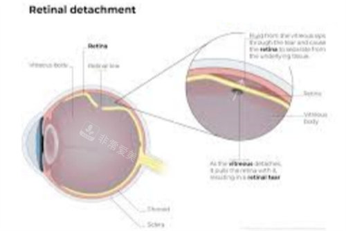 视网膜脱落眼球状况