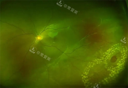 孔源性视网膜脱离灯下细节