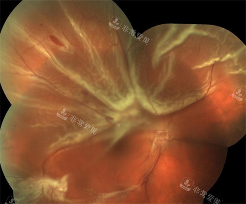 孔源性视网膜脱离放大以后得照片