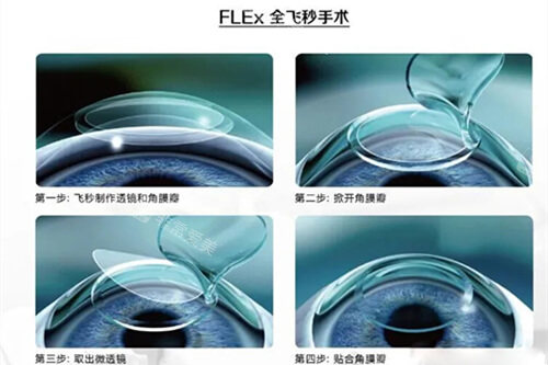 全飞秒手术过程示意图