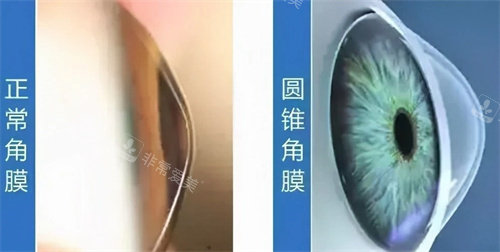 圆锥角膜和正常角膜