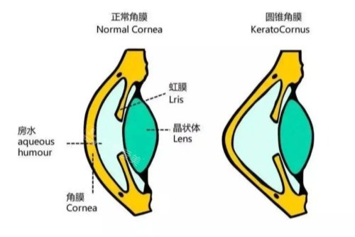 正常角膜与圆锥角膜卡通对比图
