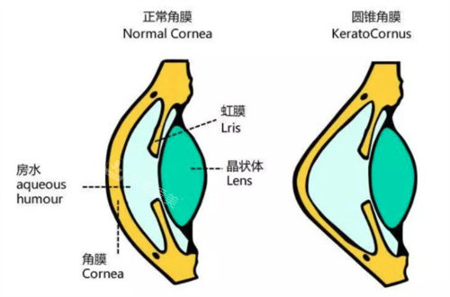 圆锥角膜和正常角膜动画