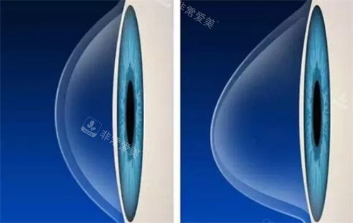 圆锥角膜和正常角膜的不同之处
