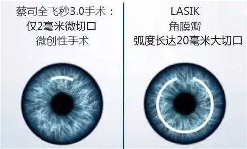 蔡司全飞秒3.0手术和LASIK对比