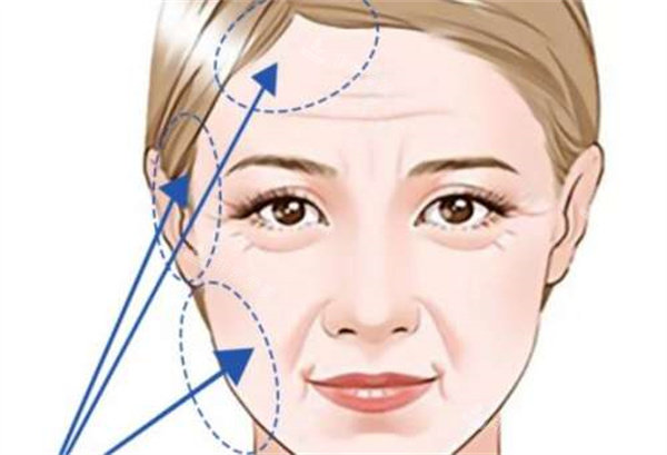 拉皮整形手术 拉皮整形手术