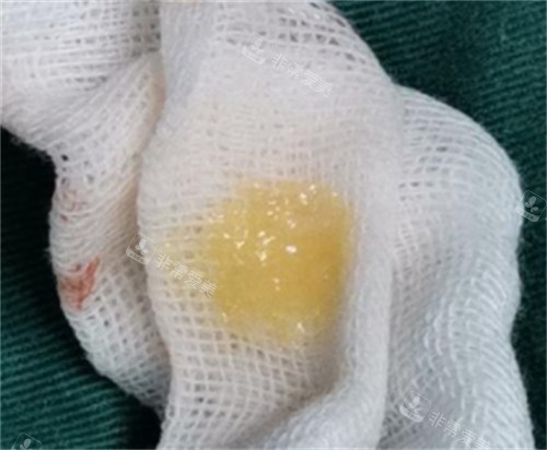 生长因子刚刚注射后取出的样子 生长因子刚刚注射后取出的样子