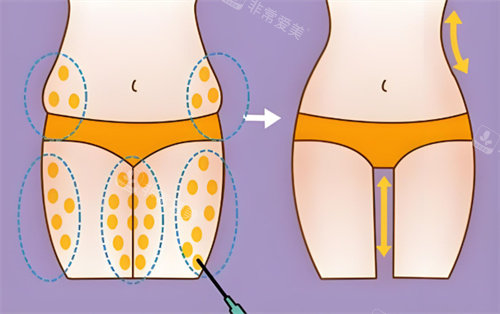 抽脂手术 抽脂手术