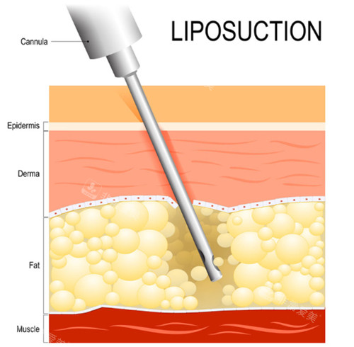 抽脂手术动画演示 抽脂手术动画演示