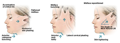 面部提升手术三种提升方向 面部提升手术三种提升方向