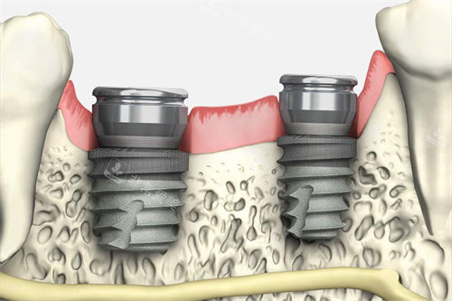 韩国多普勒种植牙植入模拟图
