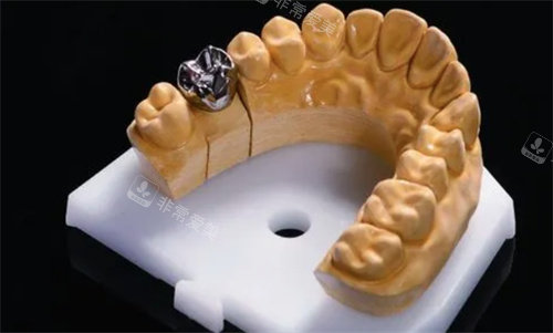 种植牙纯钛一体冠