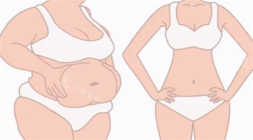 韩国全身吸脂推荐哪些整形医院？365mc医院、梦想整形、歌柔飞整形、qiline整形都是吸脂口碑好的医院！