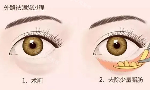 外切祛眼袋展示 外切祛眼袋展示