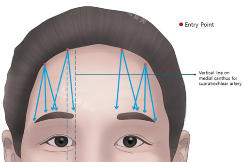 提眉前后对比分享