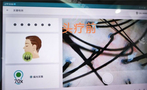 厦门重森植发治疗细节图