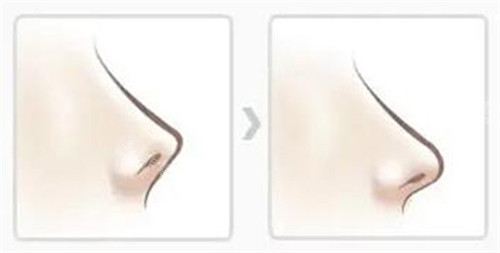 鼻子朝天矫正改善