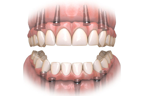 all-on-6全口种植牙示意图