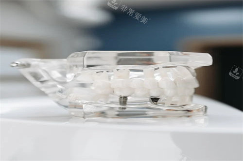 种植牙模型示意
