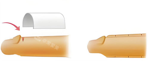 男性增粗手术示意图 男性增粗手术示意图