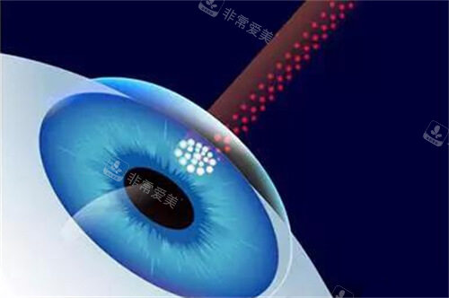 近视眼手术漫画示意图