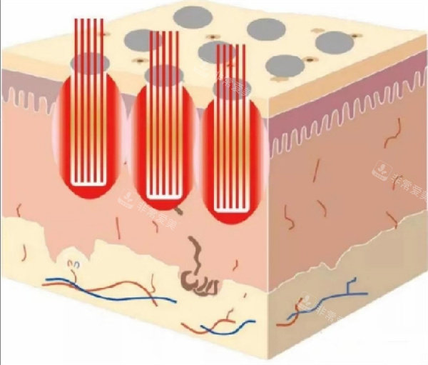 二氧化碳点阵激光操作过程