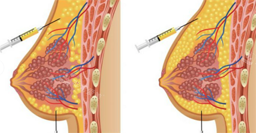 胸部奥美定注射物