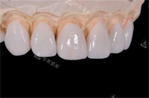 牙齿贴面修复展示