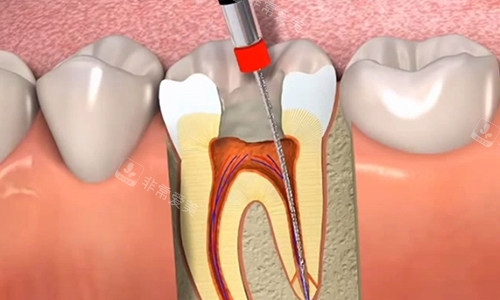 根管治疗中的过程