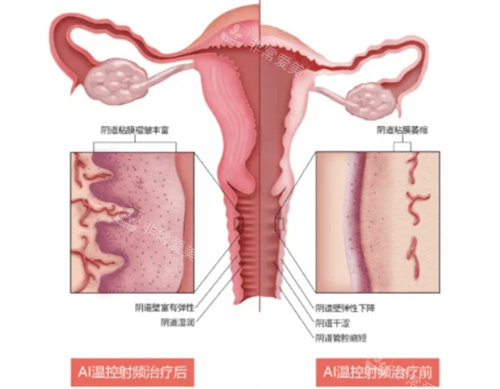 半岛FemeTite私密热玛吉功效