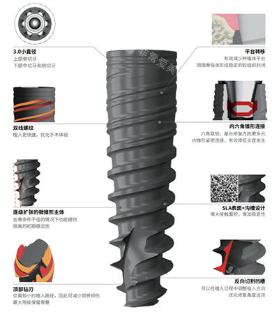 百齿泰泰锆3.0种植牙怎么样