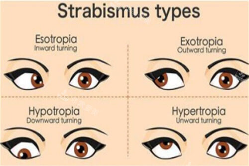 不同斜视对比图
