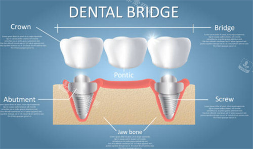 种植牙连桥冠示意图