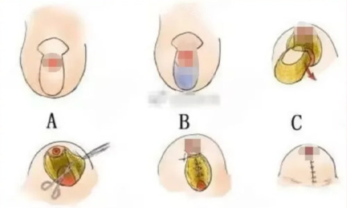 棒棒糖缩胸法（垂直双蒂法）展示