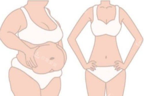 吸脂塑形对比图 吸脂塑形对比图