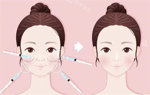 针剂注射打造幼态脸 针剂注射打造幼态脸