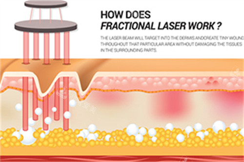 激光在皮肤中祛斑 激光在皮肤中祛斑