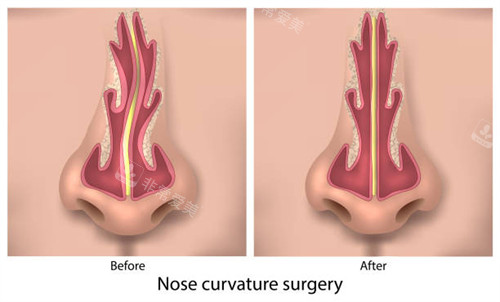 正常鼻子和歪鼻